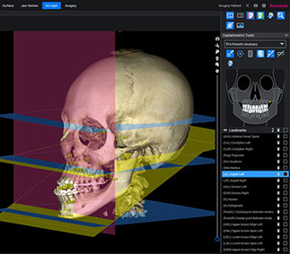 Romexis® 3D Cephalometry正確な3D分析