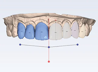 歯列矯正およびCAD/CAMとの統合